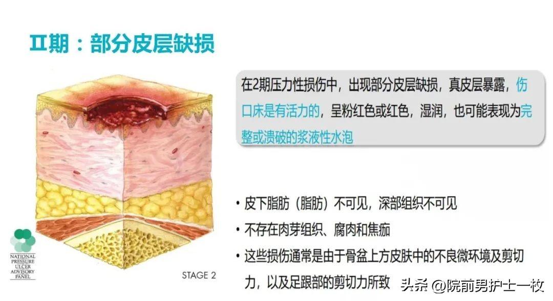 最新壓力性損傷分期介紹