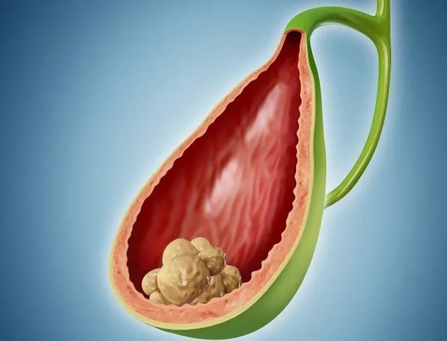 膽結石最新治療方法概述