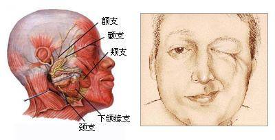 面肌痙攣最新最佳治療方法，中醫獨特之處的探索與實踐